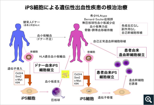 iPS細胞による遺伝性出血性疾患の根治治療